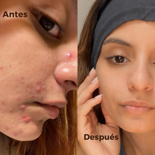 Acne Rescue kit